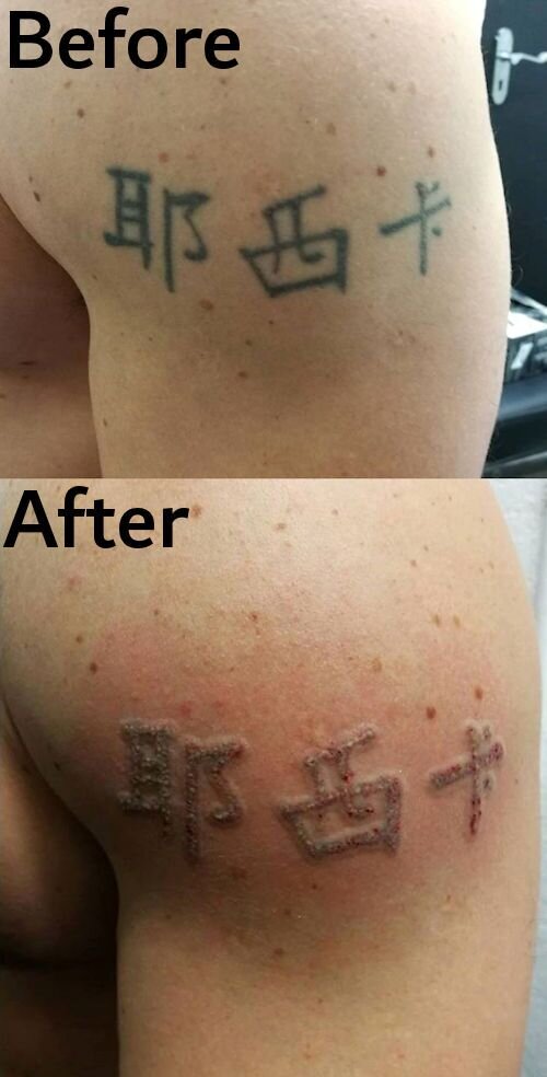 Letter removal,Dublin tattoo removal, laser tattoo removal